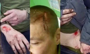 Рани на тілі бійців після знущань у штурмовому полку «Скеля»